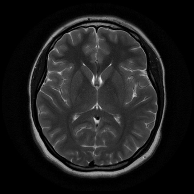 MRI Image